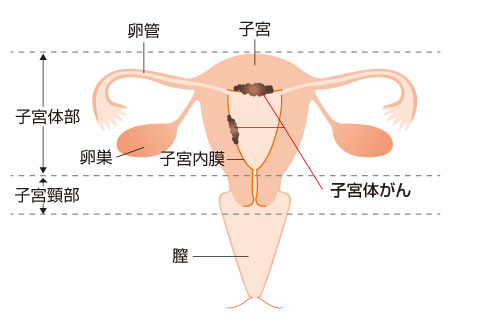 子宮体がんの位置