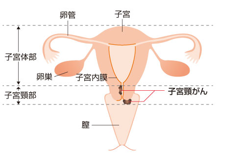子宮頸がんの位置