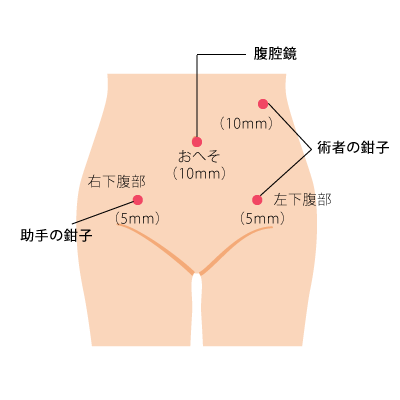 腹腔鏡下手術でおなかに開ける穴の位置　（代表的な2例）