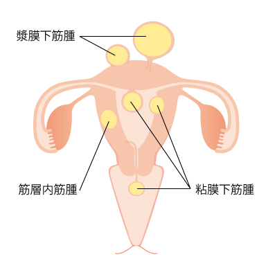 子宮筋腫の分類